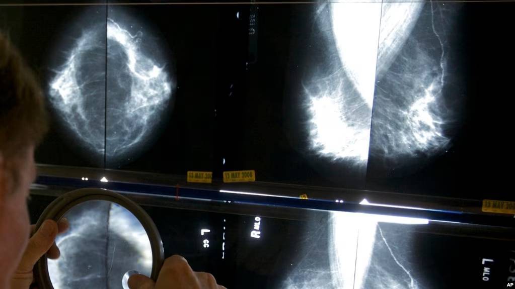 El cáncer de mama continúa siendo “el más diagnosticado entre las mujeres”
